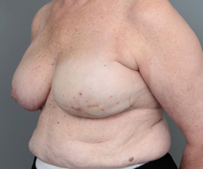 Breast Reconstruction Before & After Gallery - Patient 171934 - Image 4 - Scott Chapin, MD