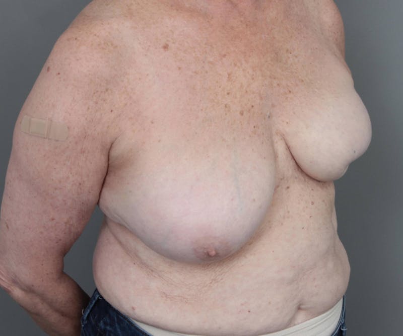 Breast Reconstruction Before & After Gallery - Patient 171934 - Image 5 - Scott Chapin, MD