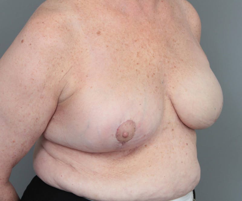 Breast Reconstruction Before & After Gallery - Patient 171934 - Image 6 - Scott Chapin, MD