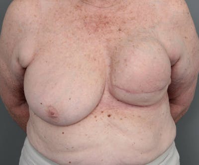 Breast Reconstruction Before & After Gallery - Patient 276086 - Image 1 - Scott Chapin, MD
