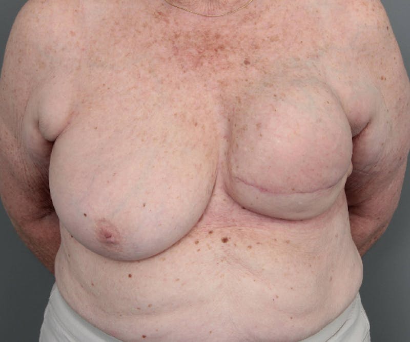 Breast Reconstruction Before & After Gallery - Patient 276086 - Image 1 - Scott Chapin, MD