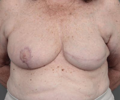 Breast Reconstruction Before & After Gallery - Patient 276086 - Image 2 - Scott Chapin, MD
