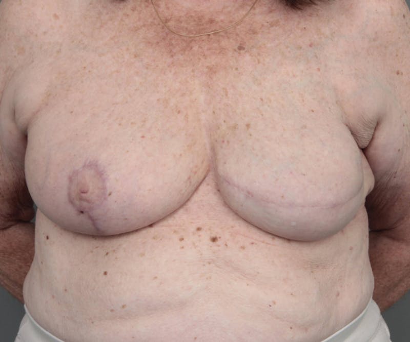 Breast Reconstruction Before & After Gallery - Patient 276086 - Image 2 - Scott Chapin, MD