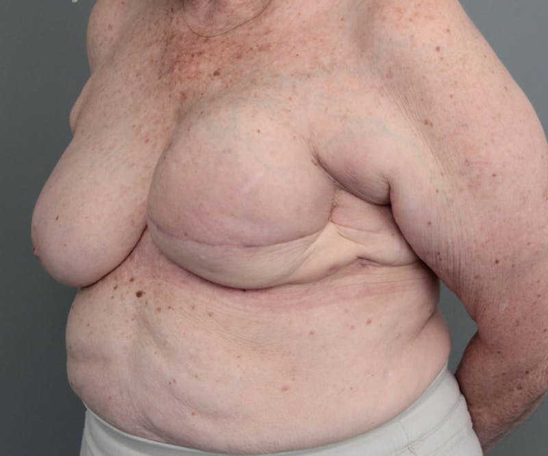 Breast Reconstruction Before & After Gallery - Patient 276086 - Image 3 - Scott Chapin, MD