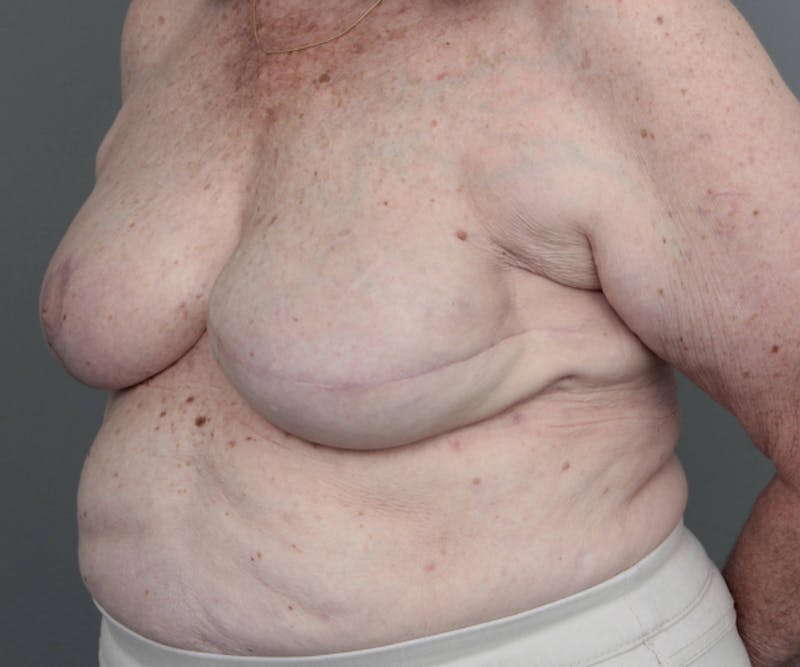 Breast Reconstruction Before & After Gallery - Patient 276086 - Image 4 - Scott Chapin, MD