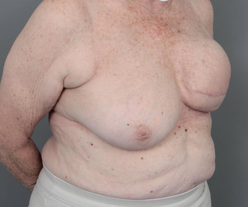 Breast Reconstruction Before & After Gallery - Patient 276086 - Image 5 - Scott Chapin, MD
