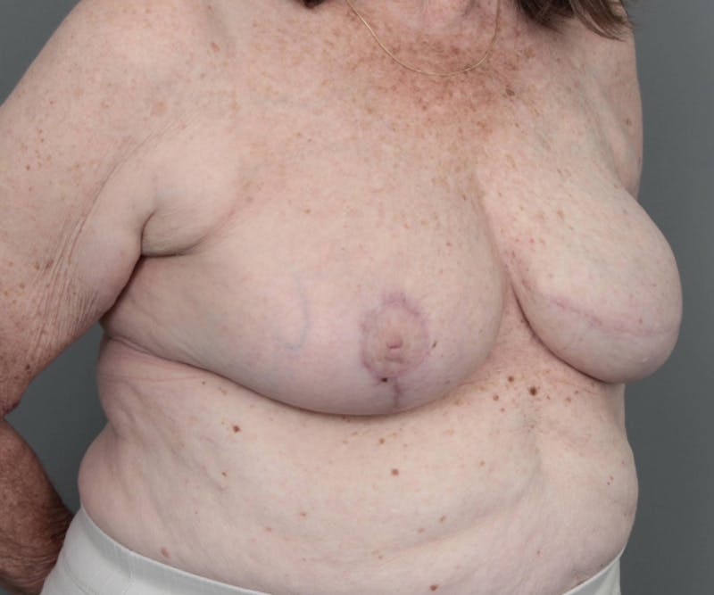 Breast Reconstruction Before & After Gallery - Patient 276086 - Image 6 - Scott Chapin, MD