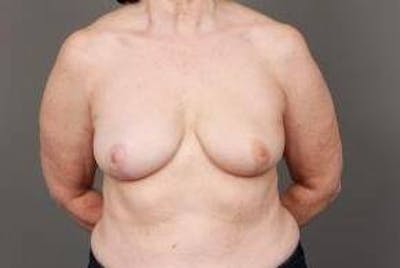 Breast Reconstruction Before & After Gallery - Patient 394553 - Image 2 - Scott Chapin, MD