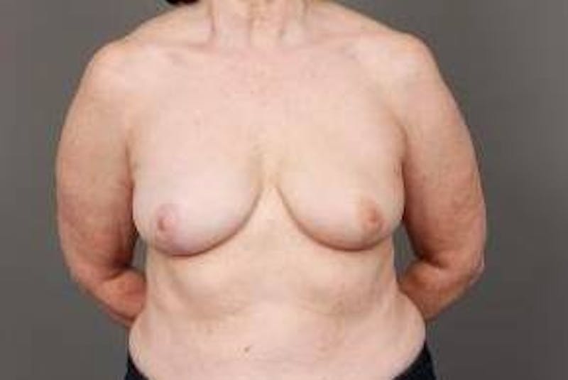 Breast Reconstruction Before & After Gallery - Patient 394553 - Image 2 - Scott Chapin, MD