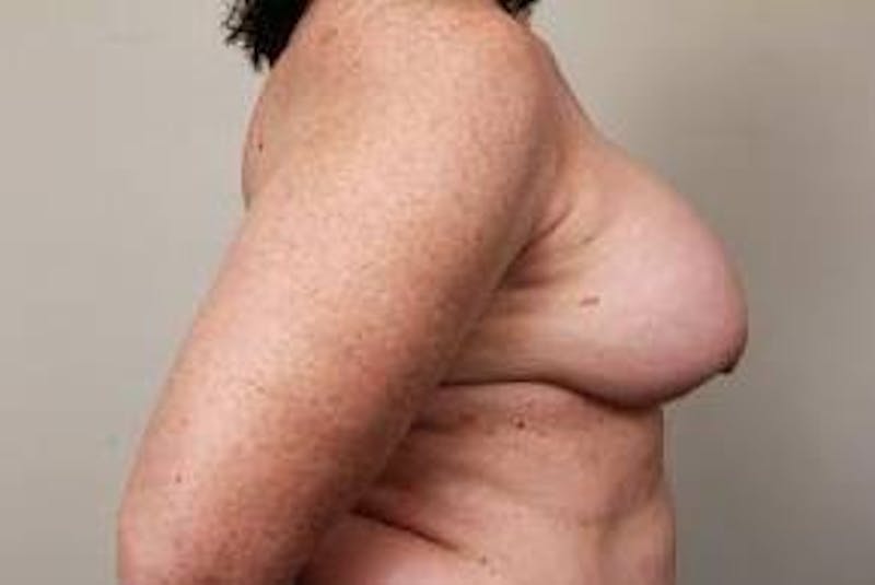 Breast Reconstruction Before & After Gallery - Patient 394553 - Image 3 - Scott Chapin, MD