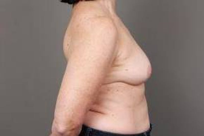 Breast Reconstruction Before & After Gallery - Patient 394553 - Image 4 - Scott Chapin, MD