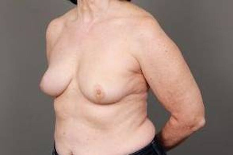 Breast Reconstruction Before & After Gallery - Patient 394553 - Image 6 - Scott Chapin, MD