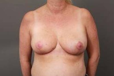 Breast Reconstruction Before & After Gallery - Patient 367900 - Image 2 - Scott Chapin, MD