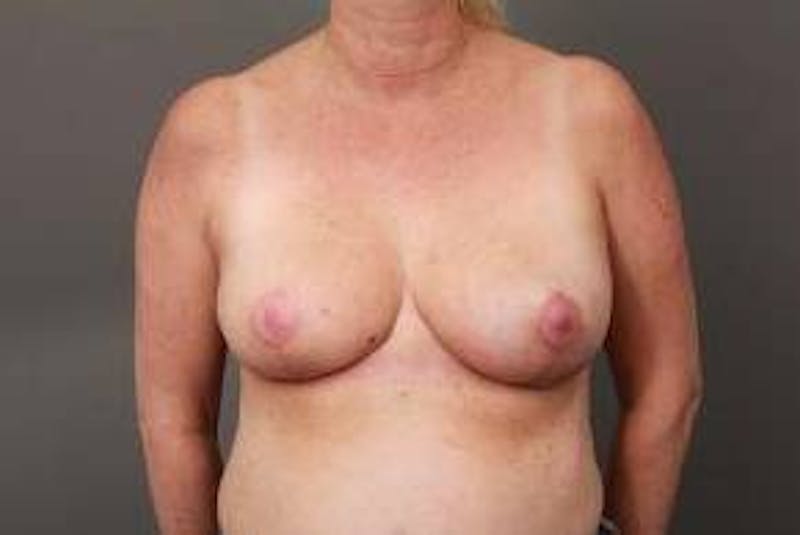 Breast Reconstruction Before & After Gallery - Patient 367900 - Image 2 - Scott Chapin, MD