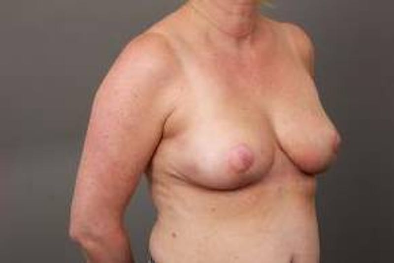 Breast Reconstruction Before & After Gallery - Patient 367900 - Image 4 - Scott Chapin, MD