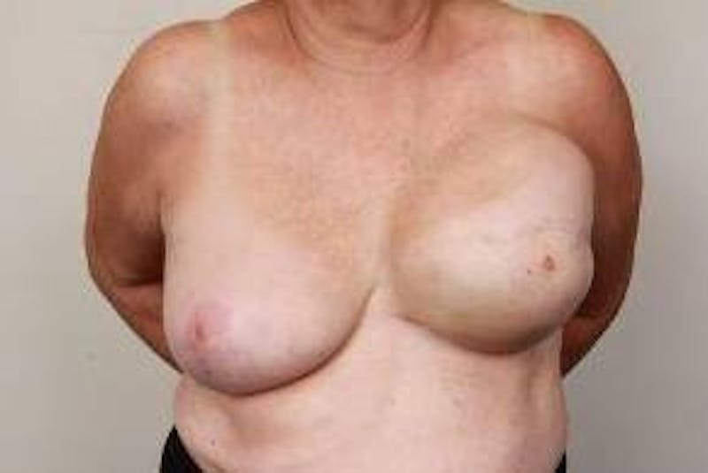 Breast Reconstruction Before & After Gallery - Patient 324400 - Image 1 - Scott Chapin, MD