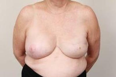 Breast Reconstruction Before & After Gallery - Patient 324400 - Image 2 - Scott Chapin, MD