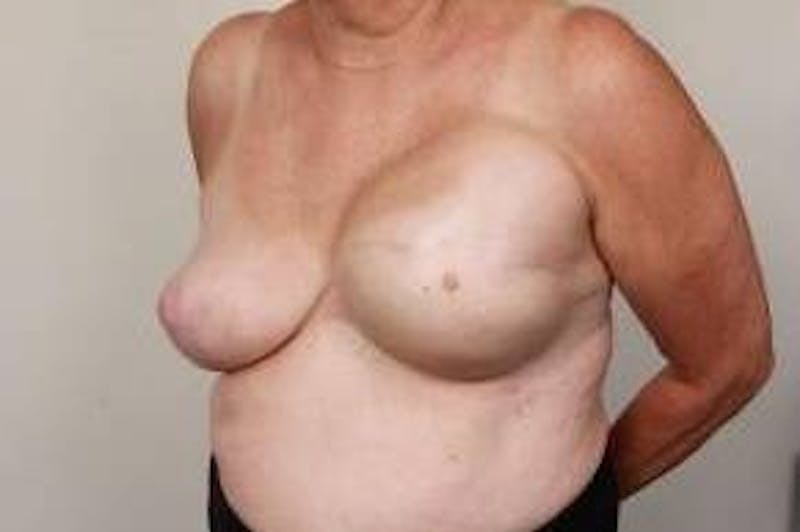 Breast Reconstruction Before & After Gallery - Patient 324400 - Image 3 - Scott Chapin, MD