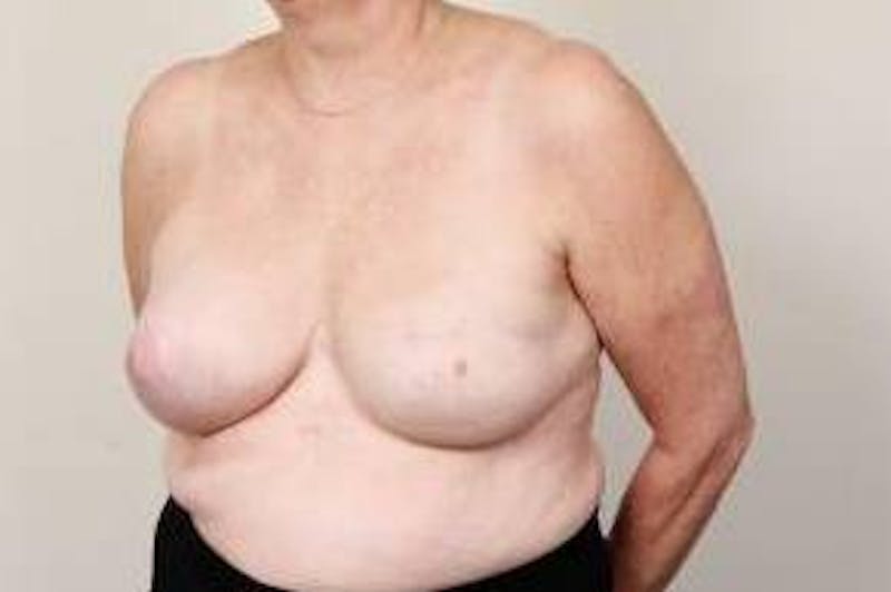 Breast Reconstruction Before & After Gallery - Patient 324400 - Image 4 - Scott Chapin, MD