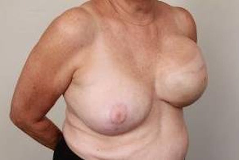 Breast Reconstruction Before & After Gallery - Patient 324400 - Image 5 - Scott Chapin, MD