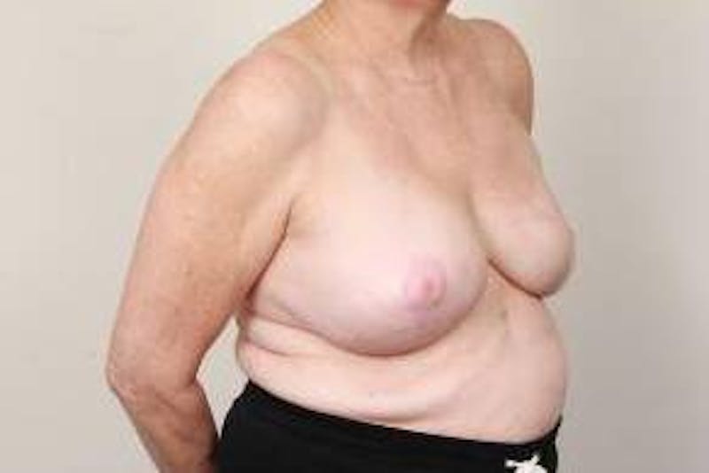 Breast Reconstruction Before & After Gallery - Patient 324400 - Image 6 - Scott Chapin, MD