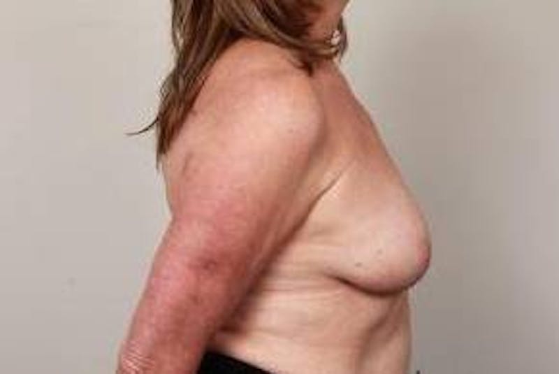 Breast Reconstruction Before & After Gallery - Patient 210342 - Image 3 - Scott Chapin, MD