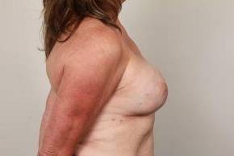 Breast Reconstruction Before & After Gallery - Patient 210342 - Image 4 - Scott Chapin, MD