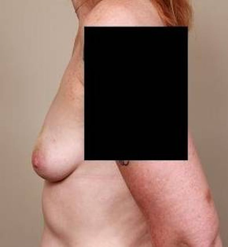 Breast Reconstruction Before & After Gallery - Patient 110655 - Image 3 - Scott Chapin, MD