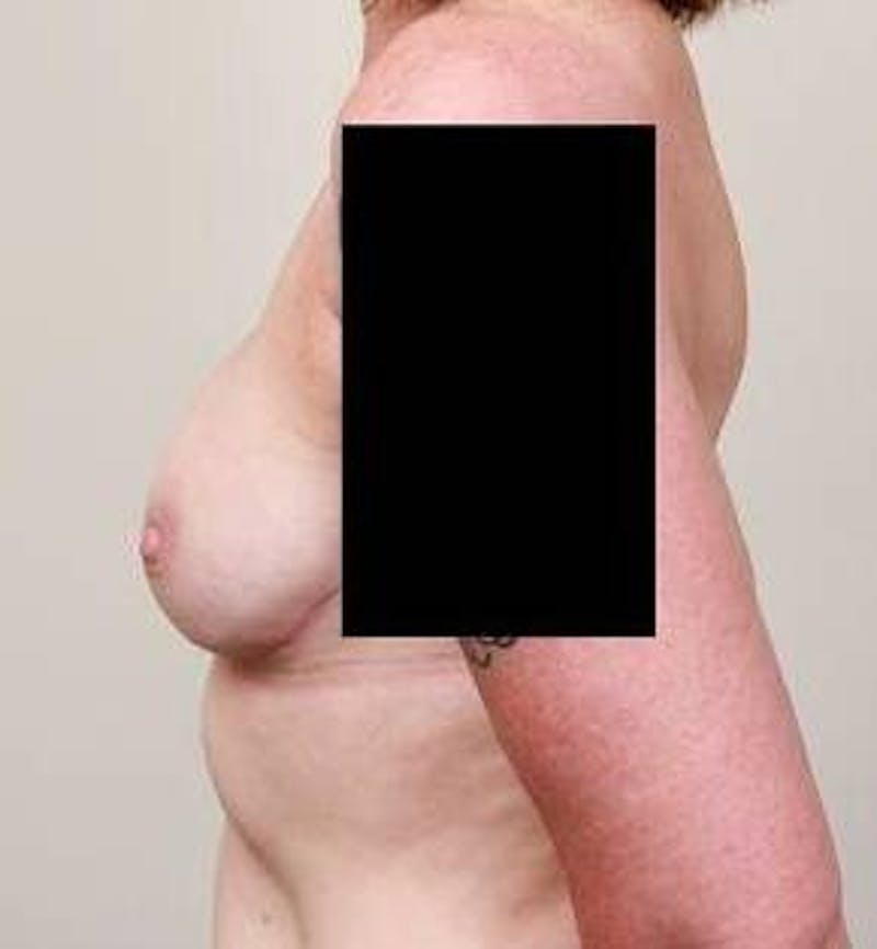 Breast Reconstruction Before & After Gallery - Patient 110655 - Image 4 - Scott Chapin, MD