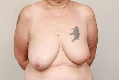 Breast Reconstruction Before & After Gallery - Patient 289382 - Image 1 - Scott Chapin, MD