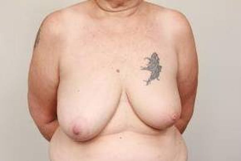 Breast Reconstruction Before & After Gallery - Patient 289382 - Image 1 - Scott Chapin, MD