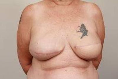 Breast Reconstruction Before & After Gallery - Patient 289382 - Image 2 - Scott Chapin, MD