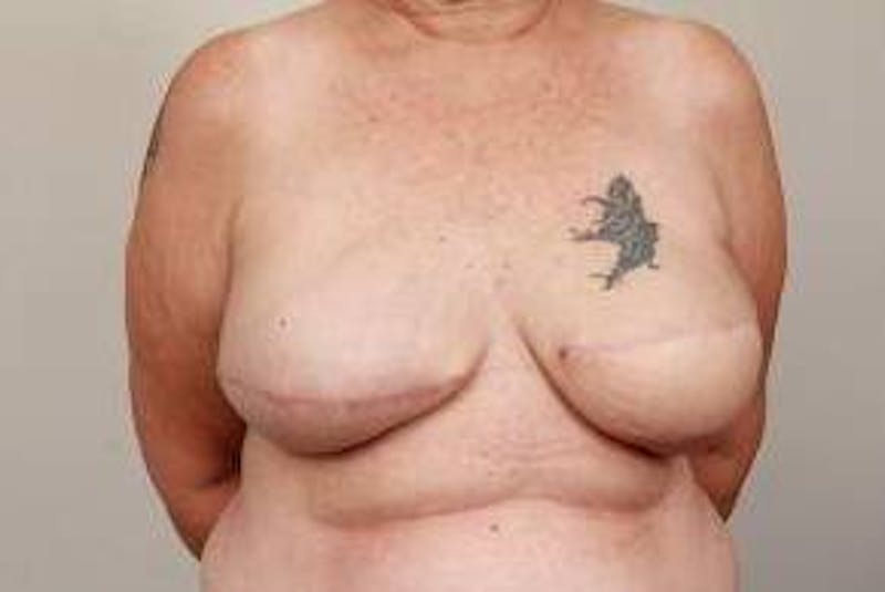 Breast Reconstruction Before & After Gallery - Patient 289382 - Image 2 - Scott Chapin, MD