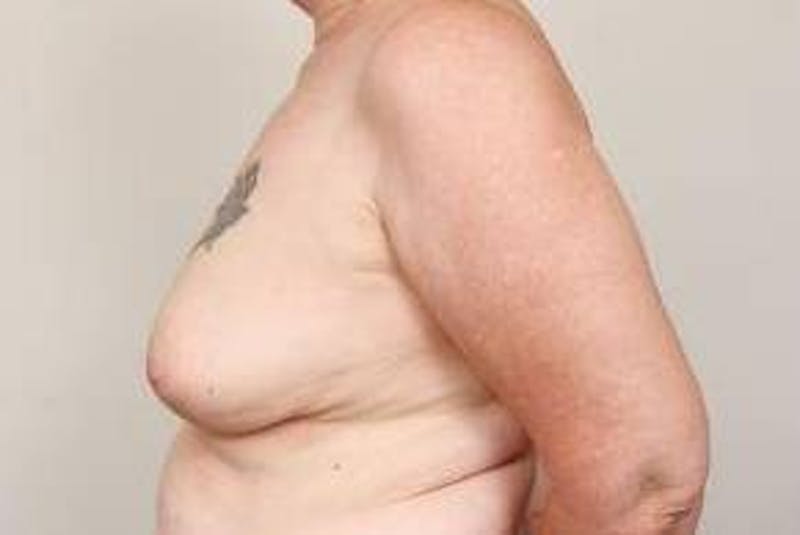Breast Reconstruction Before & After Gallery - Patient 289382 - Image 3 - Scott Chapin, MD