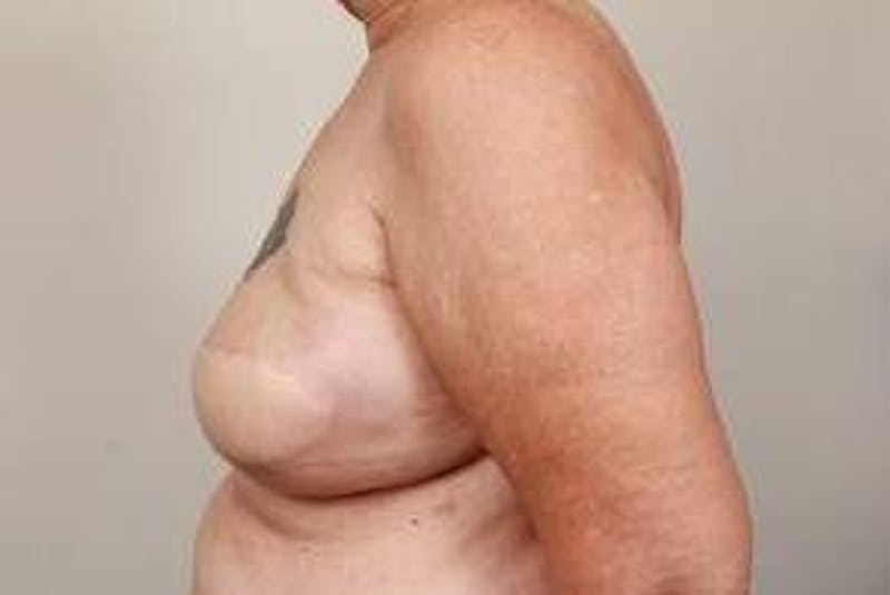 Breast Reconstruction Before & After Gallery - Patient 289382 - Image 4 - Scott Chapin, MD