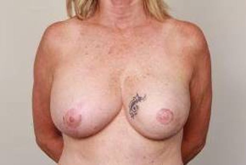 Breast Reconstruction Before & After Gallery - Patient 398735 - Image 2 - Scott Chapin, MD