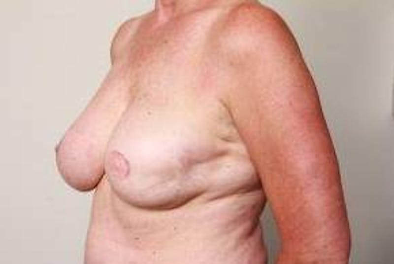 Breast Reconstruction Before & After Gallery - Patient 398735 - Image 3 - Scott Chapin, MD