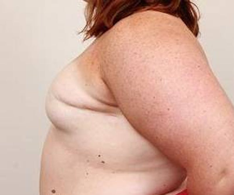 Breast Reconstruction Before & After Gallery - Patient 137434 - Image 3 - Scott Chapin, MD