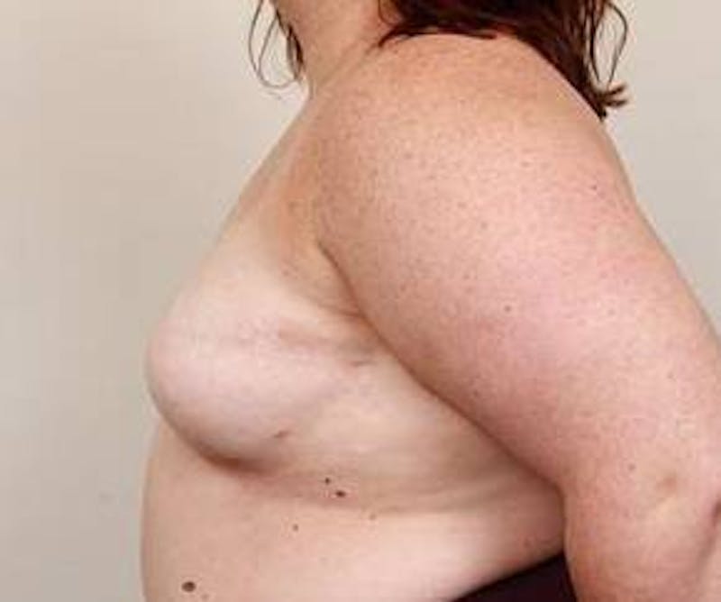 Breast Reconstruction Before & After Gallery - Patient 137434 - Image 4 - Scott Chapin, MD