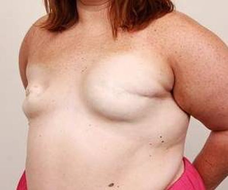 Breast Reconstruction Before & After Gallery - Patient 137434 - Image 5 - Scott Chapin, MD