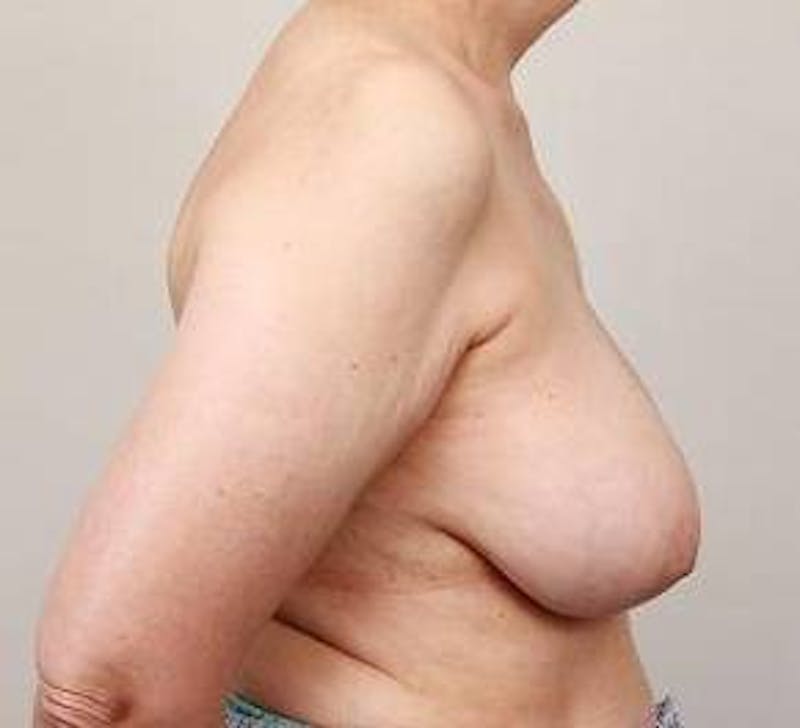 Breast Reconstruction Before & After Gallery - Patient 180041 - Image 3 - Scott Chapin, MD