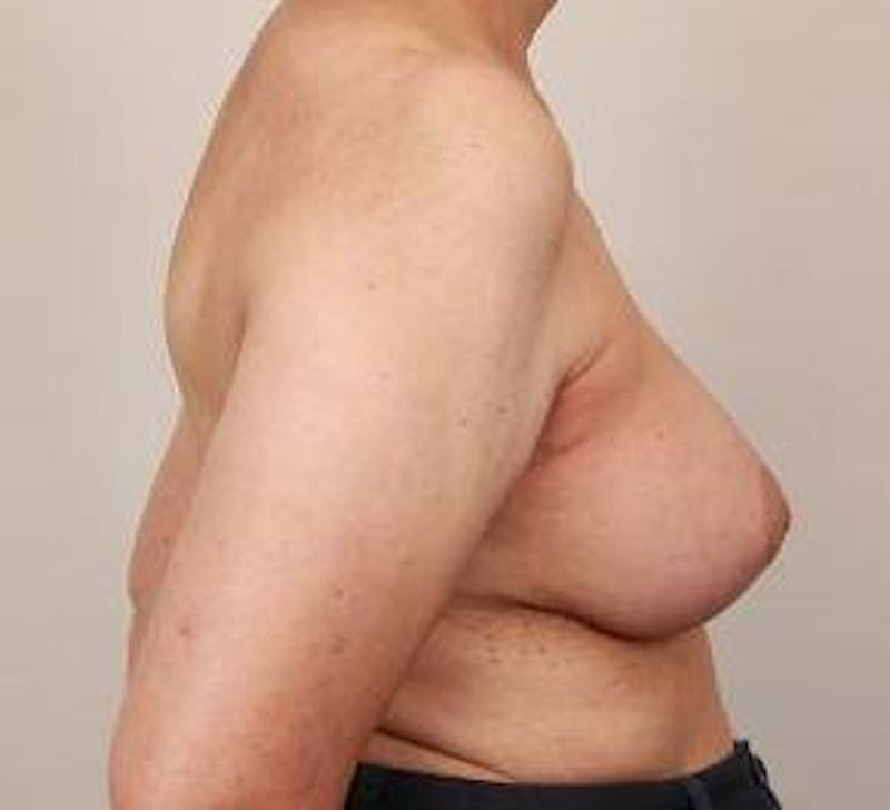 Breast Reconstruction Before & After Gallery - Patient 180041 - Image 4 - Scott Chapin, MD