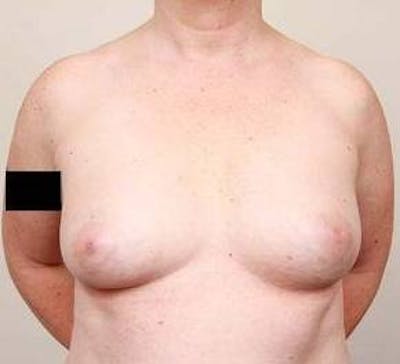 Breast Reconstruction Before & After Gallery - Patient 129603 - Image 1 - Scott Chapin, MD
