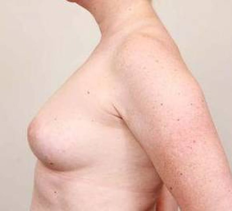 Breast Reconstruction Before & After Gallery - Patient 129603 - Image 3 - Scott Chapin, MD