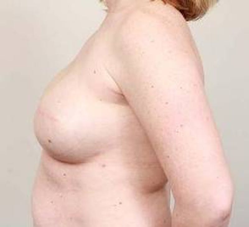 Breast Reconstruction Before & After Gallery - Patient 129603 - Image 5 - Scott Chapin, MD