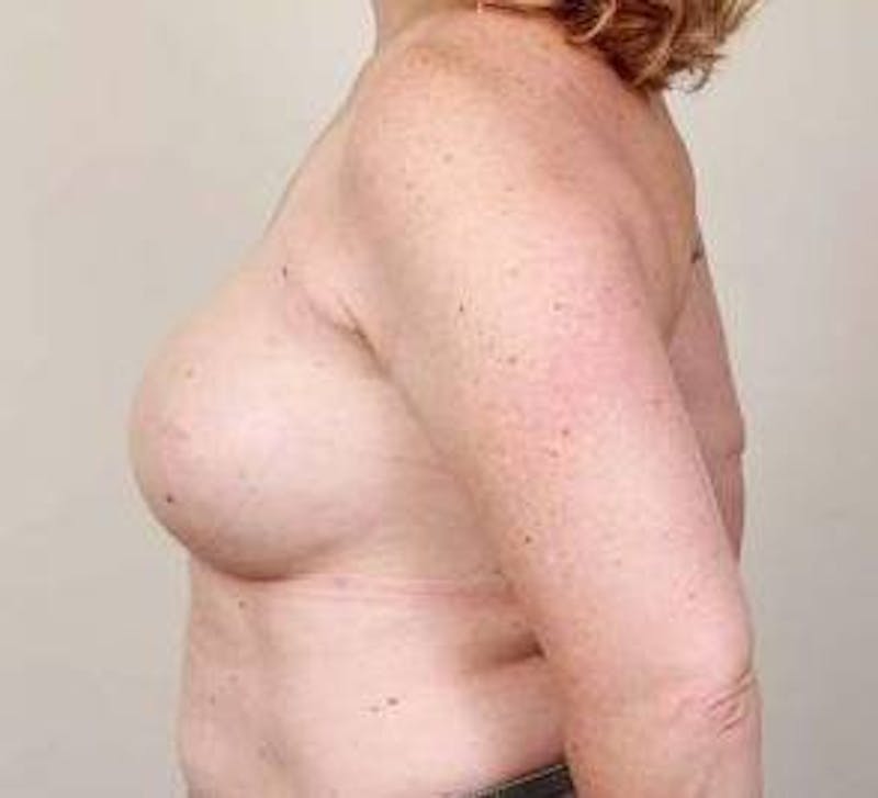 Breast Reconstruction Before & After Gallery - Patient 129603 - Image 6 - Scott Chapin, MD