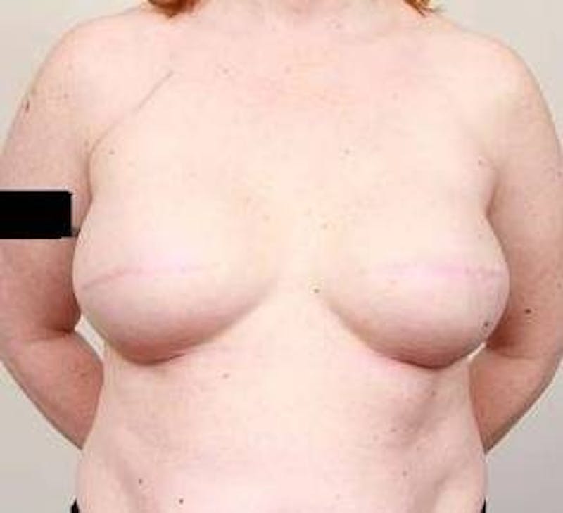 Breast Reconstruction Before & After Gallery - Patient 129603 - Image 7 - Scott Chapin, MD