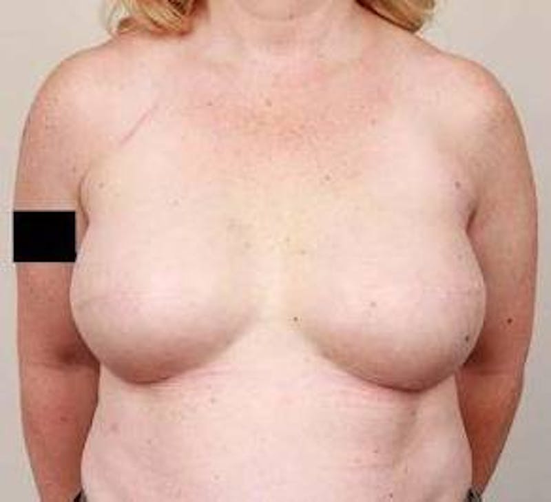 Breast Reconstruction Before & After Gallery - Patient 129603 - Image 8 - Scott Chapin, MD