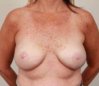Breast Reconstruction Before & After Gallery - Patient 265055 - Image 2 - Scott Chapin, MD