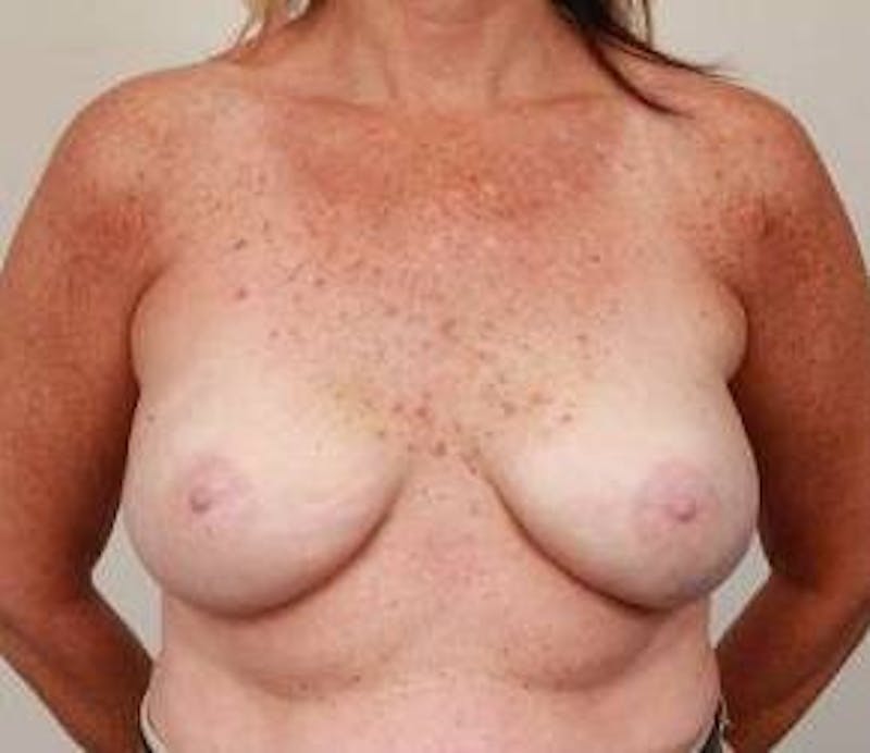 Breast Reconstruction Before & After Gallery - Patient 265055 - Image 2 - Scott Chapin, MD